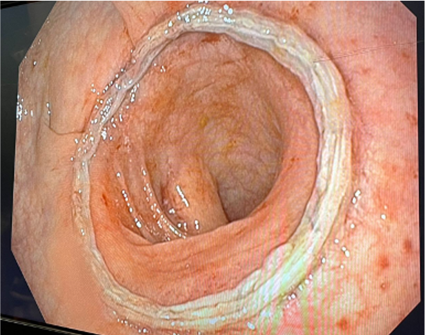 📢 Latest publication: "Perioperative assessment of colorectal anastomoses with flexible endoscopy" 
Linkhttps://www.researchgate.net/publication/386318909_Perioperative_assessment_of_colorectal_anastomoses_with_flexible_endoscopy
#ColorectalSurgery #Innovation #Endoscopy