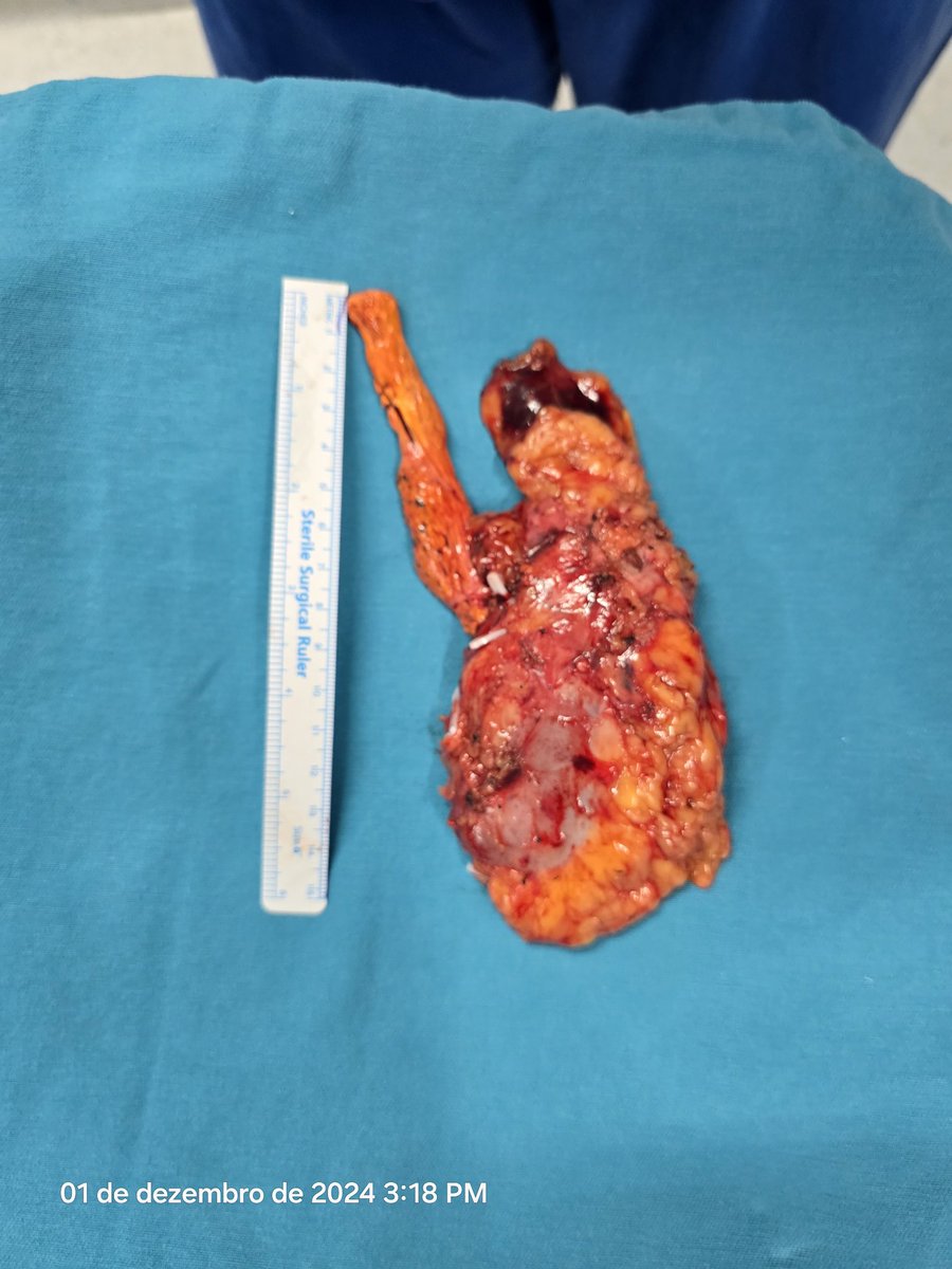 Rafael Coelho (@rafaelfcoelho2) on Twitter photo Happy Sunday
Level III robotic vena cava thrombectomy Happy Sunday
Level III robotic vena cava thrombectomy