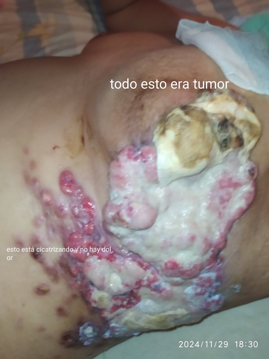 decofiestasyari's tweet image. 🆘 Ángeles, voy mejorando, gracias por tanto, aún necesito ayuda, por favor no me dejen sola. El jueves es la próxima sesión de Quimioterapia. Meta $350.  0102 04249014646 10302119 paypal.me/yaritza70 Zelle al privado. GRACIAS 🆘