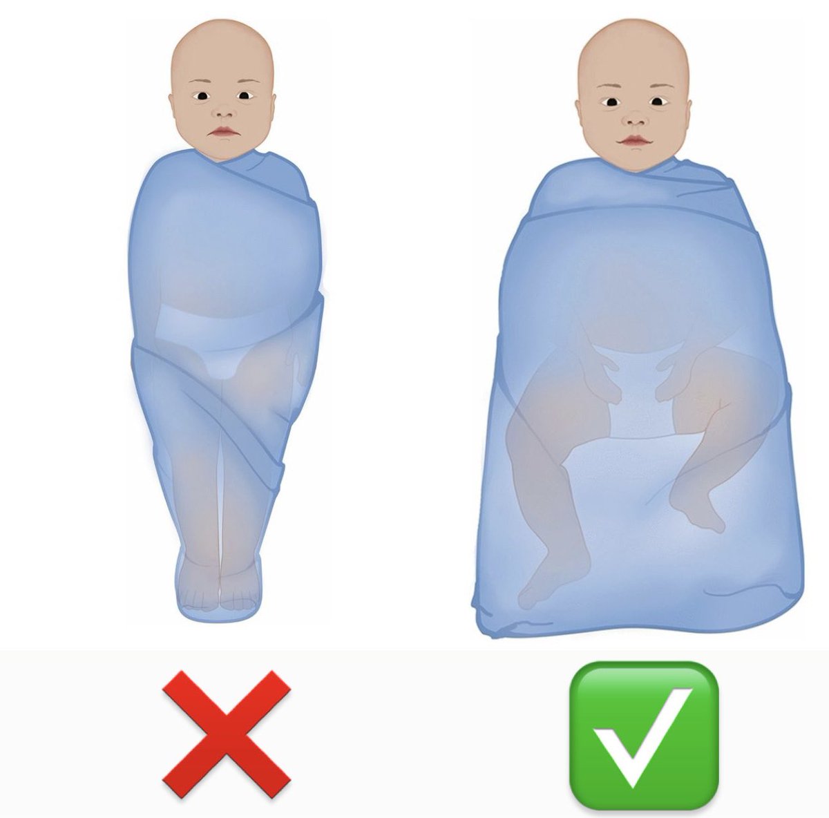 Bedong kencang &amp; meluruskan seluruh anggota gerak hingga gerakan terbatas meningkatkan risiko displasia panggul 6x lipat yang memengaruhi cara jalan &amp; tingkatkan risiko pengapuran saat dewasa.

Jangan salah lagi, ya! Tidak perlu bedong stlh bayi bs berguling (usia 3 bulan).