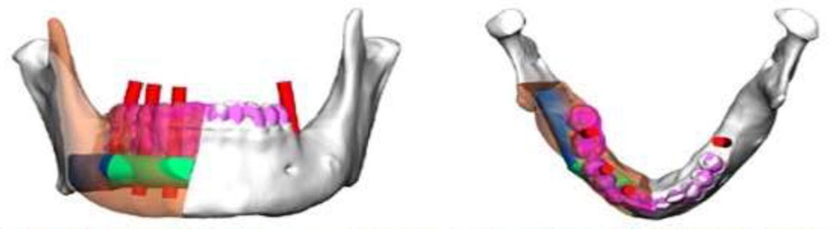 NEW PUBLICATION from the team in the British Journal of Oral and Maxillofacial Surgery titled: 'Quality of Life Outcomes in Patients Receiving Dental Implants in Vascularised Bone Flaps for Mandibular Reconstruction'. 

👉 Click here to read more: lnkd.in/g7n9yQdg