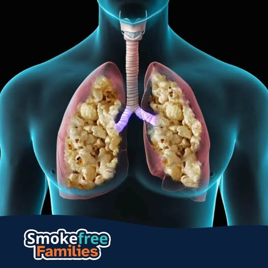 Popcorn-Lunge Diagnose Electron Transfer As A Potential Cause Of Diacetyl  Toxicity In Popcorn Lung Disease Australia Popcorn-Lunge Symptome