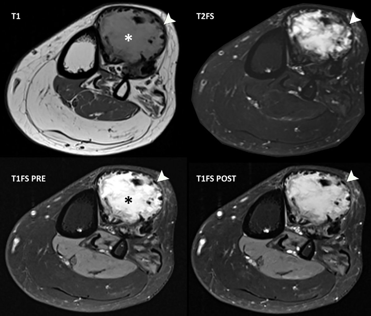 Radiologia MSK - Hospital Clínic Barcelona tweet media