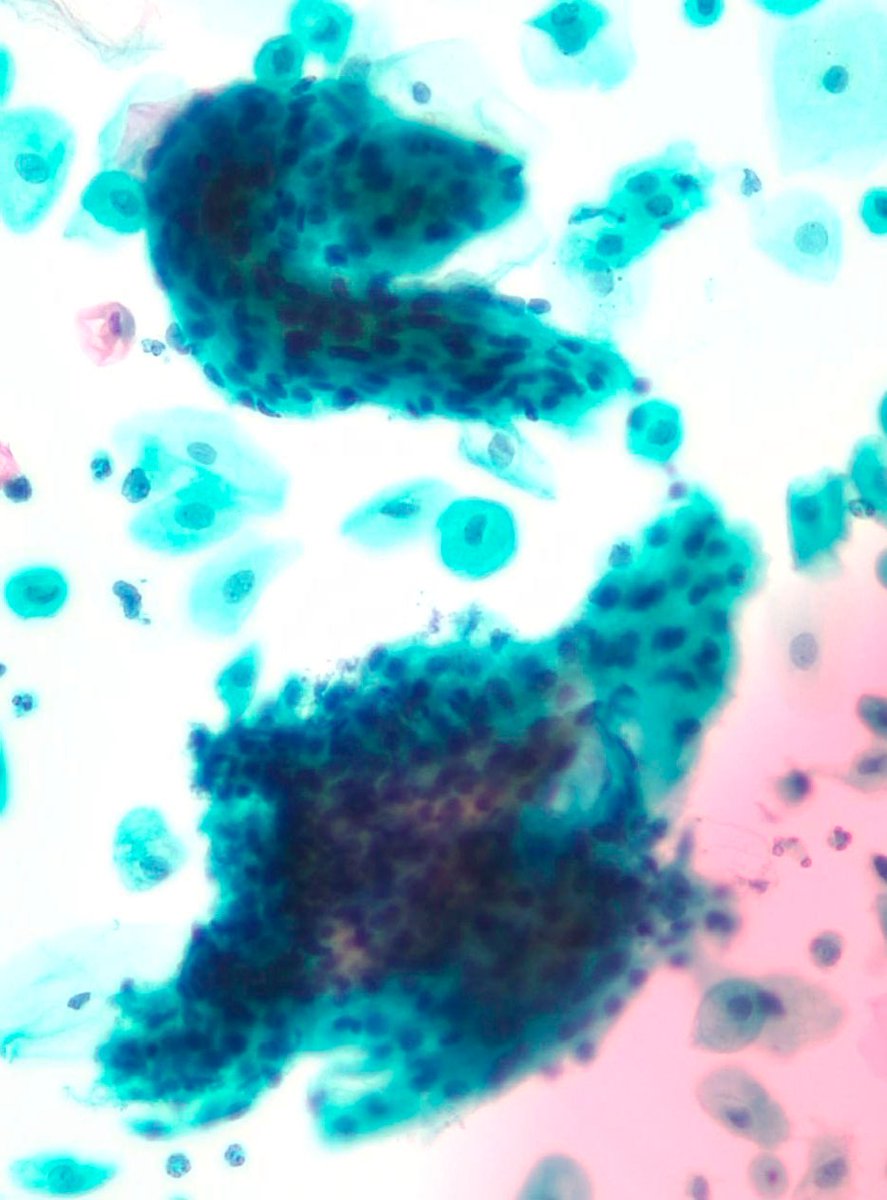 Lola Lozano (@mdlozanoe) on Twitter photo An “unexpected swan” in a Pap smear 🦢
Cytology never ceases to amaze us #Cytopath #Cytolovers #GYNcytology <a href="/EfcsYoung/">Young EFCS</a> An “unexpected swan” in a Pap smear 🦢
Cytology never ceases to amaze us #Cytopath #Cytolovers #GYNcytology <a href="/EfcsYoung/">Young EFCS</a>