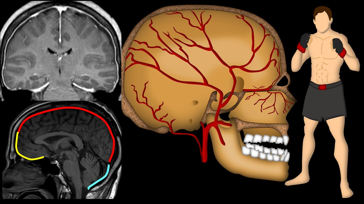 1/Ready for a throw down? 

MMA fights get a lot of attention, but MMA (middle meningeal art) &amp; dural blood supply doesn’t get the attention it deserves.

A thread on dural vascular anatomy!
