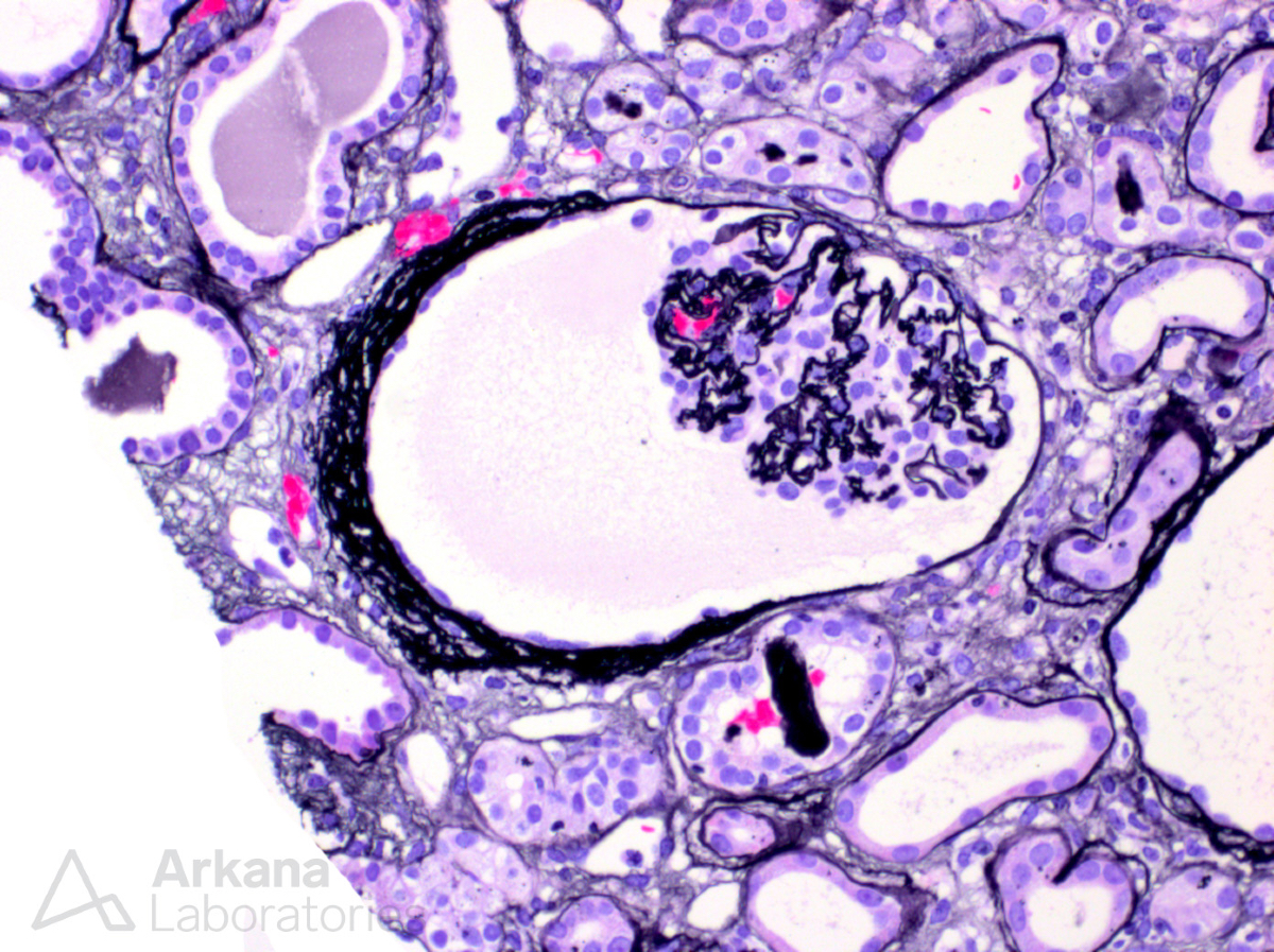 arkanalabs's tweet image. What renal state do these glomerular changes represent? 

#DiagnoseThis #renalpath #nephropath