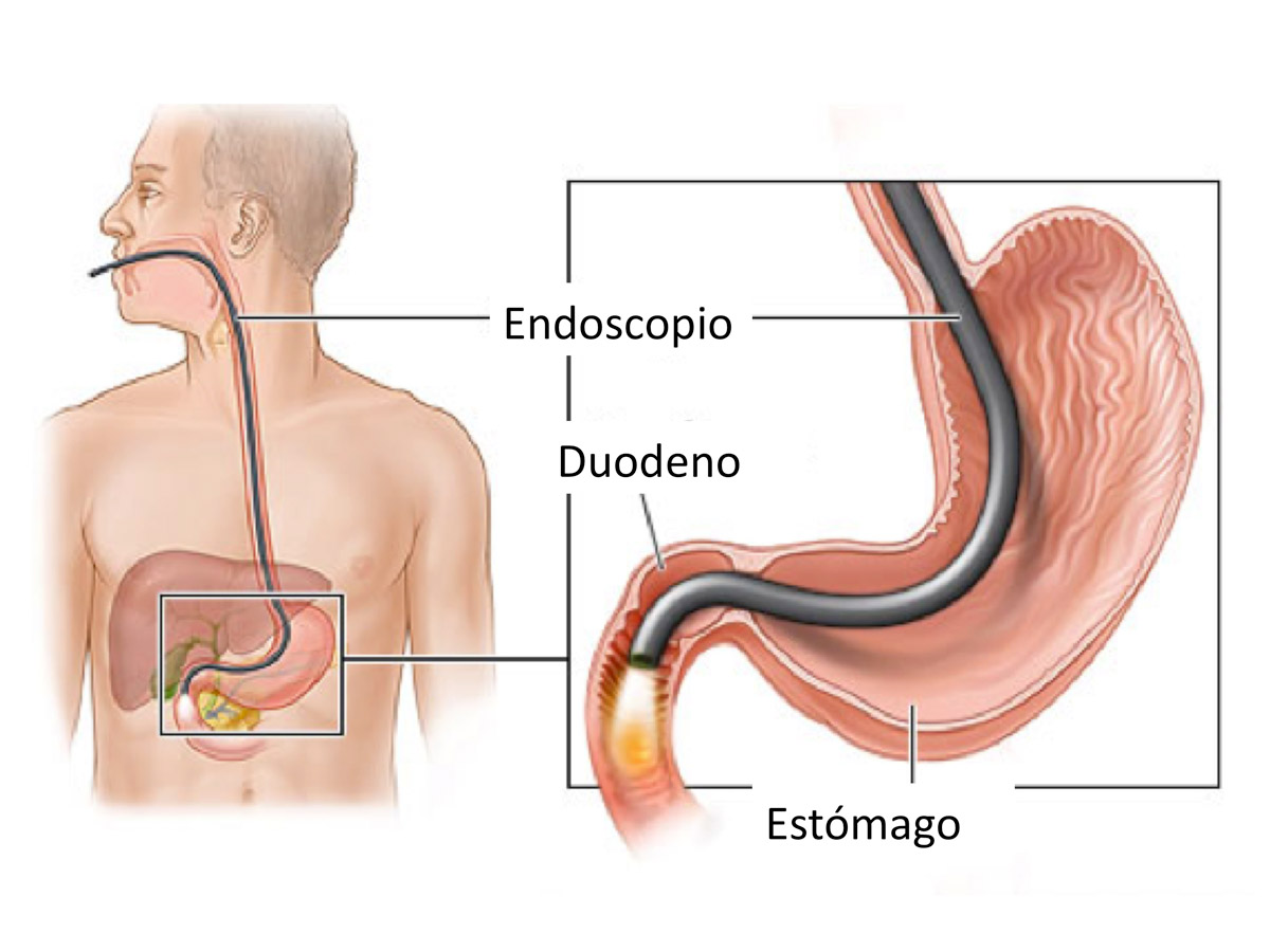 rafa_ch95's tweet photo. Actualmente según la ASGE las indicaciones correspondientes a esofagoduodenoscipia o endoscopia de tracto intestinal alto son las siguientes, abro hilo. https://t.co/kk7w1n9Uod