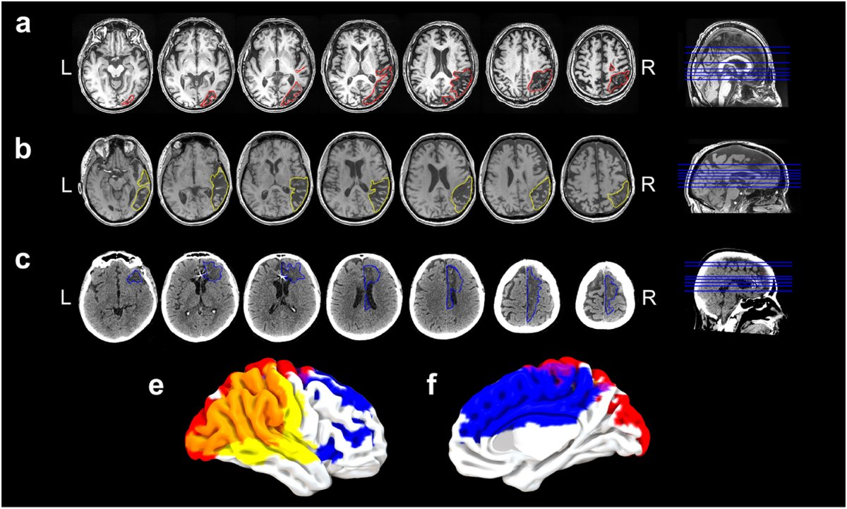 Through detailed assessments of 3 cases, we identified hallmark symptoms of AHS, including magnetic apraxia (object-induced grasping), levitation, and bimanual incoordination. Despite overlapping symptoms, our patients' distinct lesion locations showed no common cortical damage.