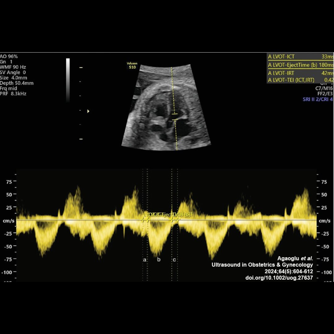 Agaoglu et al. report in #UOGJournal that fetal systolic and diastolic cardiac function is affected in pregnancies with maternal iron deficiency anemia, supporting that iron supplementation and anemia treatment are essential in prenatal follow-up. bit.ly/3UQwlvA