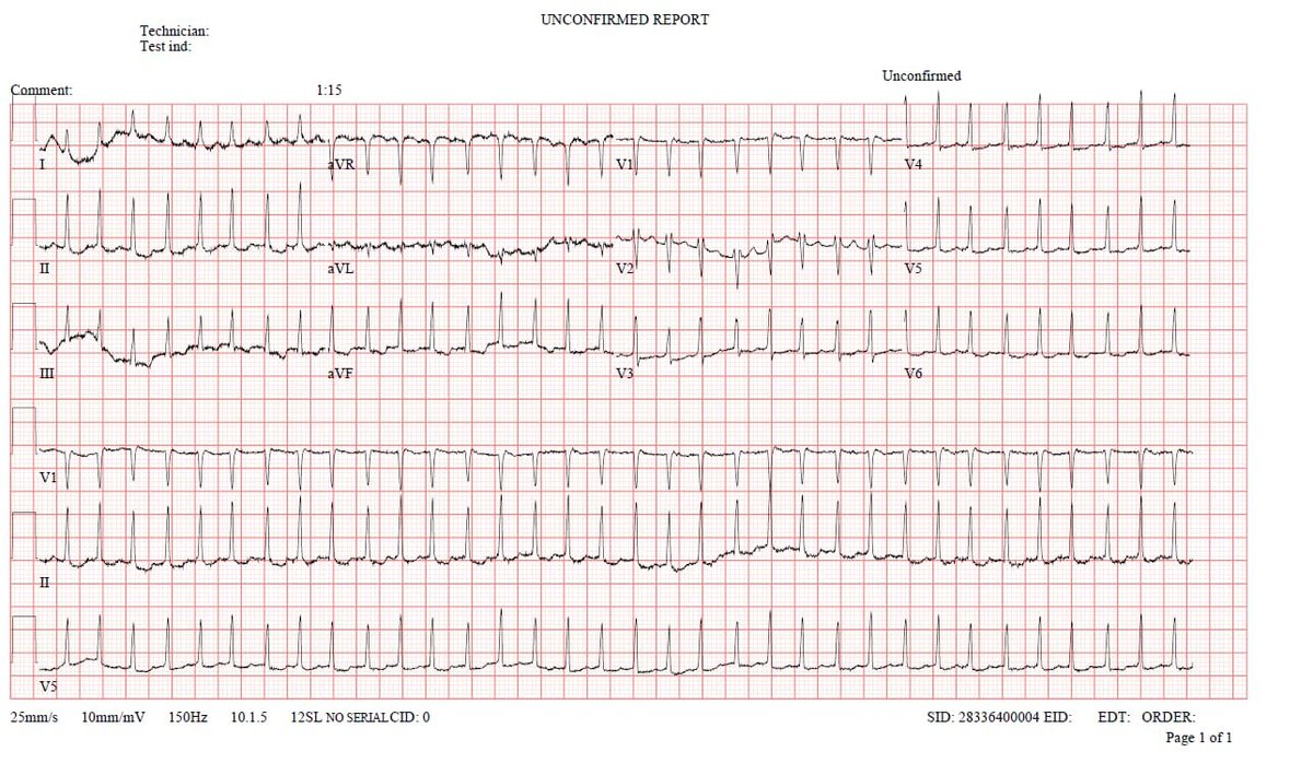 A patient in the emergency with palpitations.

What's the rhythm?