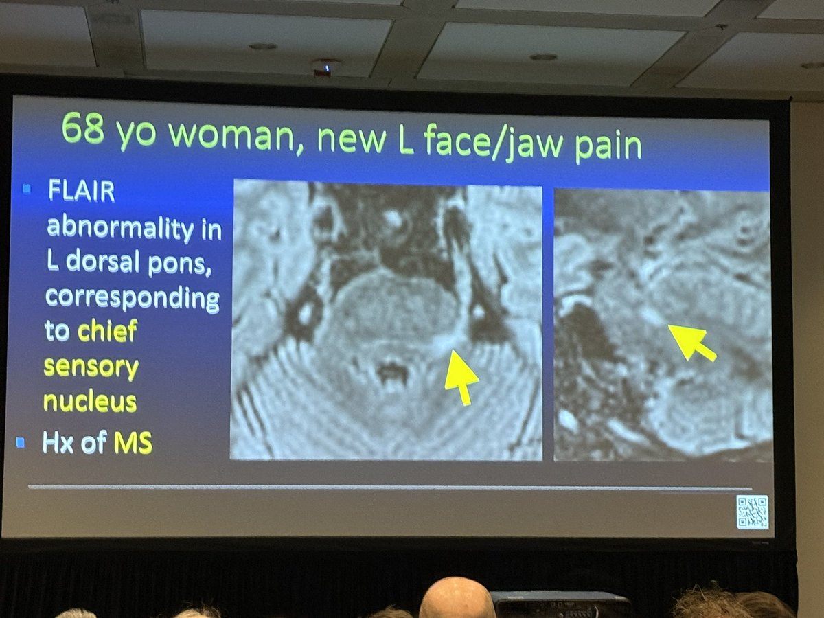 Kim Seifert, MD, MS (@kseifertmd) on Twitter photo Always a great presentation from <a href="/CynXinWu/">Cynthia Xin Wu</a> about imaging of the trigeminal nerve #RSNA24 Always a great presentation from <a href="/CynXinWu/">Cynthia Xin Wu</a> about imaging of the trigeminal nerve #RSNA24