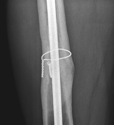 traumaticum's tweet photo. all wrapped up @ 9months, 3yrs post injury https://t.co/uBcg91reCZ