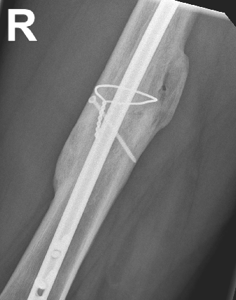 traumaticum's tweet photo. all wrapped up @ 9months, 3yrs post injury https://t.co/uBcg91reCZ