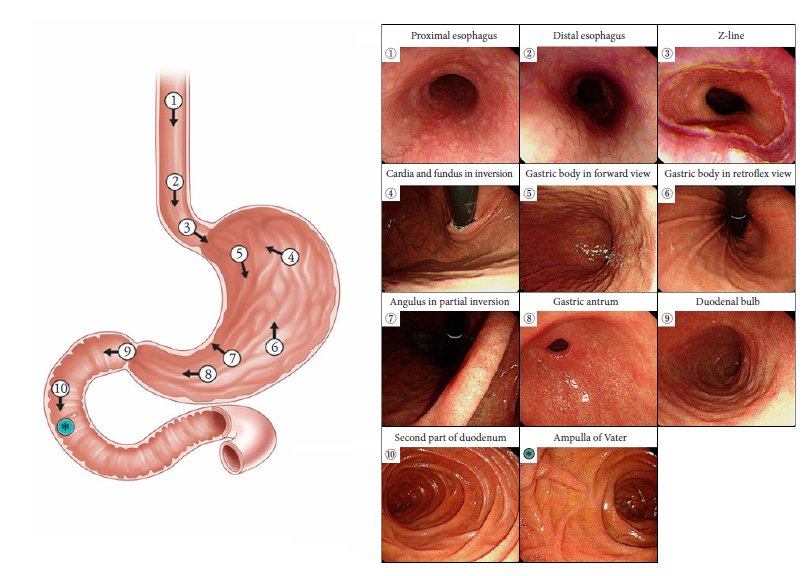 rafa_ch95's tweet photo. Se coloca en decúbito lateral izquierdo y se procede a insertar endoscopio de manera gentil. 
Se busca de manera intencionada los siguientes puntos anatómicos: https://t.co/afm4Mr7p8p