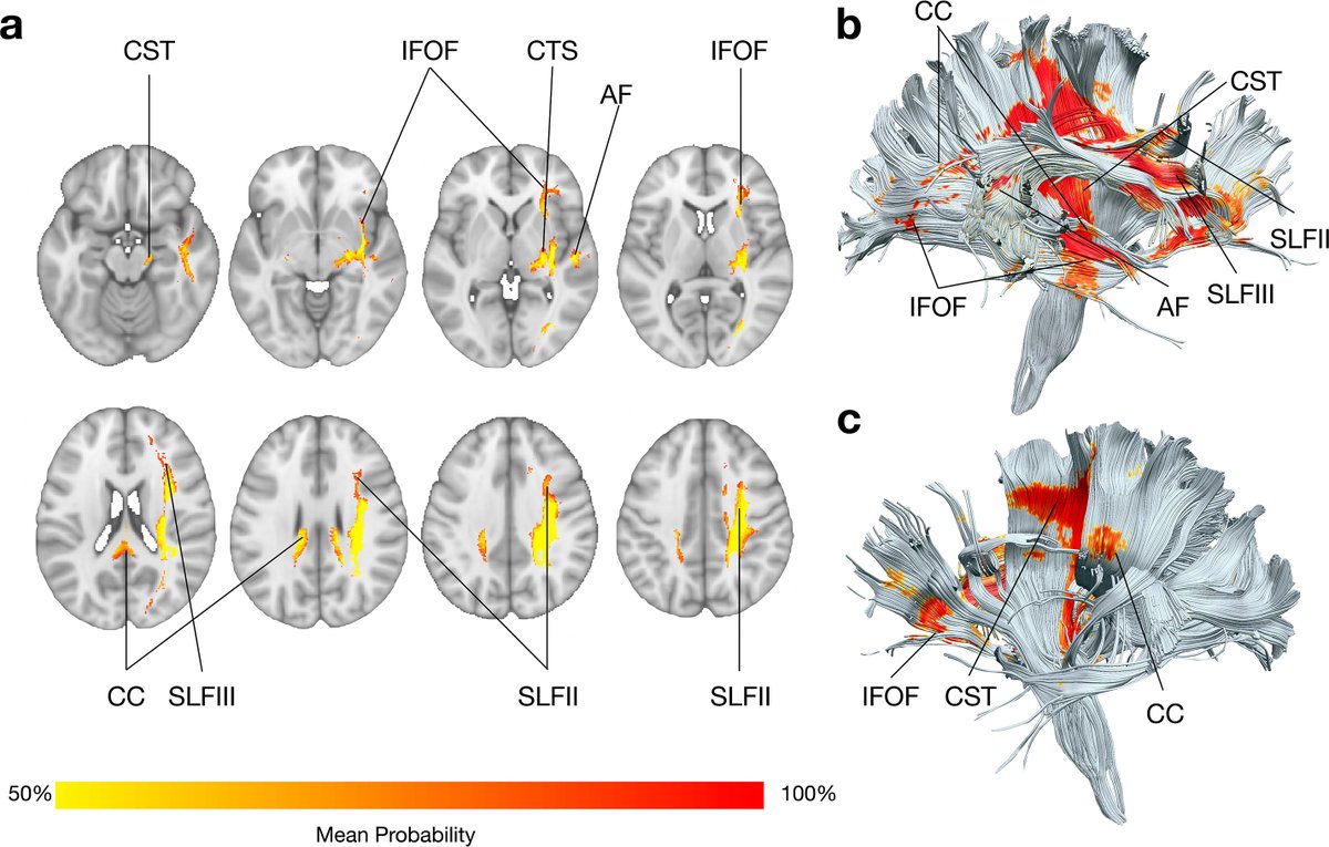 Thus, we indirectly explored white matter involvement in all 3 patients, revealing a shared disconnection pattern  critical for action initiation and purposefulness. These disruptions underpin both "productive" (e.g., grasping) and "negative" (e.g., action failure) AHS symptoms.