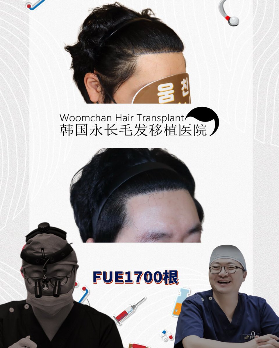 lee910907's tweet photo. FUE1700根加密髮際線
FUE1700 Hairs after 12months
 모발이식1700모 12개월 경과 
微信/  line👉woomchan
whatsapp: +821097895827
https://t.co/IWnWgwD2kc
 #韓國免剃髮植髮 #永長植髮 #woomchan永長植髮 #韩国植发医院 #韩国植髮費用 #hairtransplantsurgery #韓國免剃发植发 #FUE免剃发植 https://t.co/vl3zeEN27g