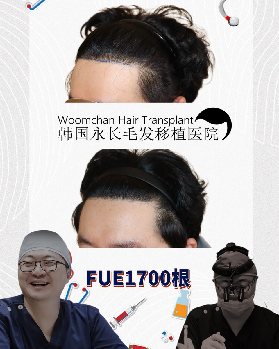 lee910907's tweet photo. FUE1700根加密髮際線
FUE1700 Hairs after 12months
 모발이식1700모 12개월 경과 
微信/  line👉woomchan
whatsapp: +821097895827
https://t.co/IWnWgwD2kc
 #韓國免剃髮植髮 #永長植髮 #woomchan永長植髮 #韩国植发医院 #韩国植髮費用 #hairtransplantsurgery #韓國免剃发植发 #FUE免剃发植 https://t.co/vl3zeEN27g