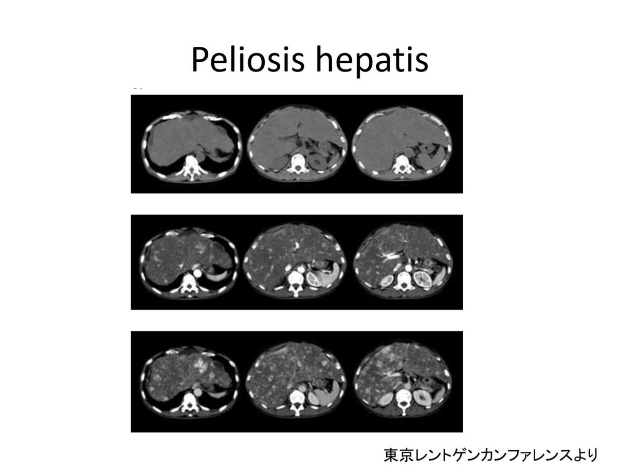 MZZxALW5qPiPmRv's tweet photo. Peliosis hepatis
•消耗疾患（悪性腫瘍、結核）、薬剤（ステロイド、抗がん剤）、薬物、感染症、感染症（HIVなど）、移植後、血液疾患など
•拡張した血洞がランダムに分布
•数mm～3cm
•画像所見は海綿状血管腫に類似～異なるものまで多彩
#Rdiag https://t.co/bbCUmkjah9