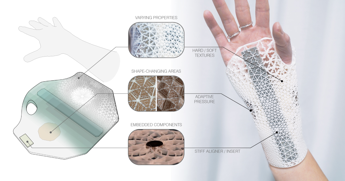 multimeso's tweet photo. This #4Dprinted personalized #orthosis provides adaptive fit and comfort by integrating soft/stiff surfaces, moisture-activated #shapechanging zones, and insertable components such as magnets and aligners into a highly #functional device for the #medical and #sports industries. https://t.co/XRKaQTO0ic
