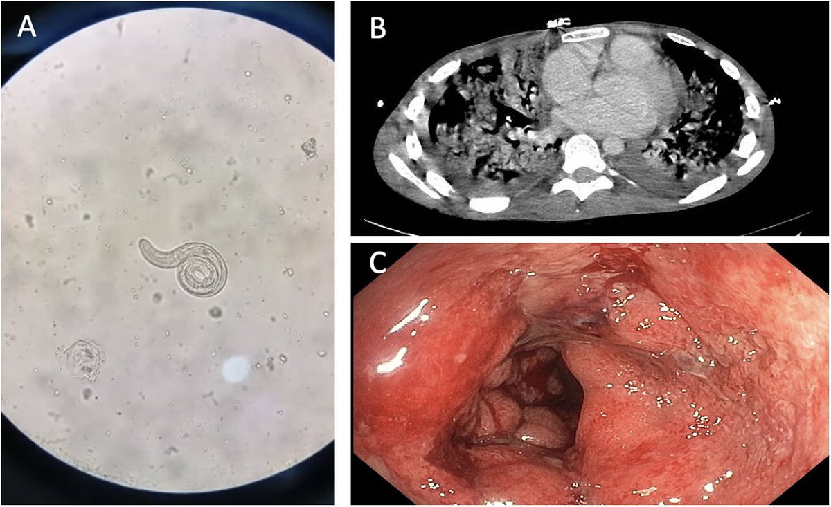 Hiperinfestación por Strongyloides stercolaris en paciente inmunodeprimido por enfermedad inflamatoria intestinal. elsevier.es/es-revista-gas…