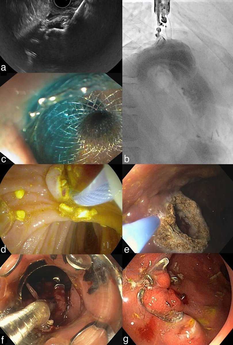 Endoscopic ultrasound-directed transgastric ERCP (EDGE) – An effective approach for bile duct stone treatment after gastric bypass. elsevier.es/es-revista-gas…