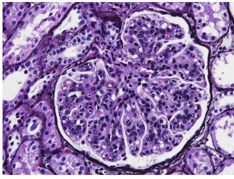 AJKDonline's tweet photo. #RenalPath: Glomerulonephritis with dominant C3 demonstrating endocapillary hypercellularity (Jones silver stain). 

https://t.co/r7ZRkyJxbv (FREE) https://t.co/uznaU3X3J9