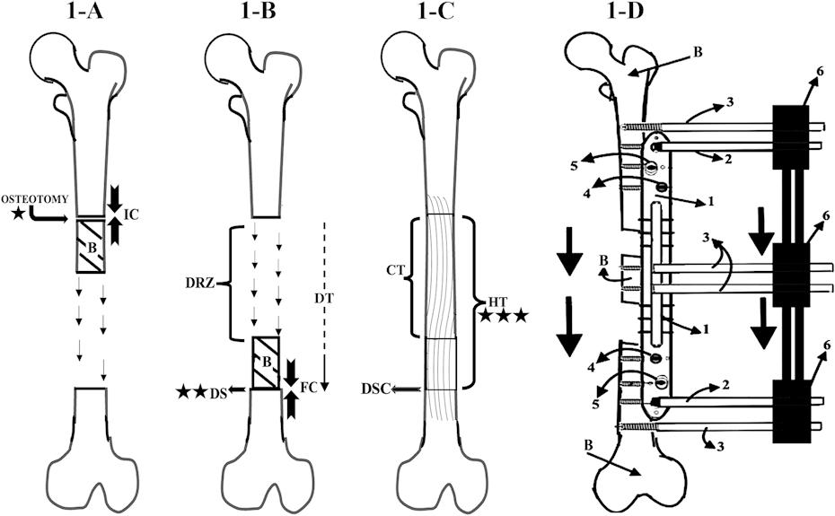 Effective Compression and a Minimally Invasive Rail Plate to Optimize Bone Transport in Distraction Osteogenesis

bit.ly/49r2cJ5