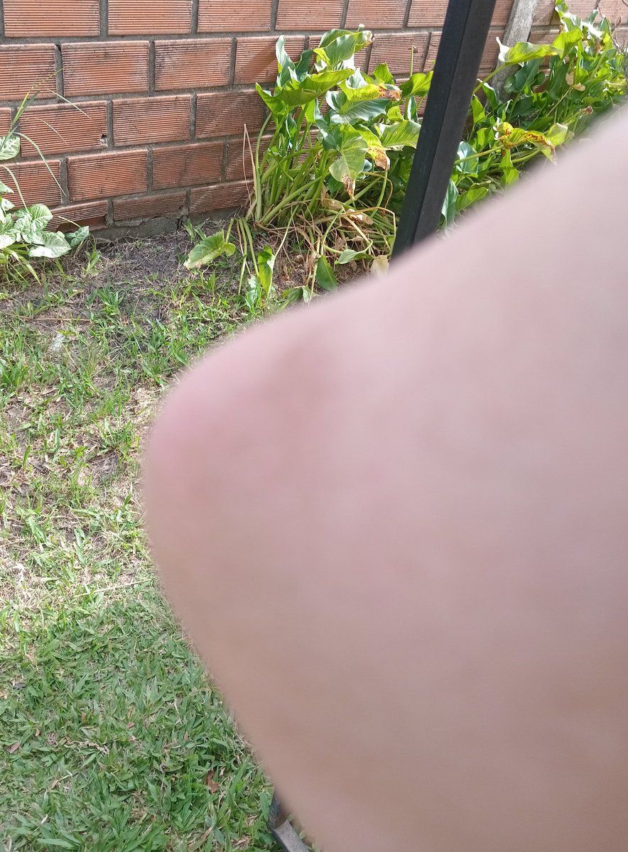 FurmanElias's tweet photo. Anoche no hubo milagro para mi y no junté para remedios.
Hoy mi codo derecho amaneció así 👇.
Terrible dolores por la deformación y las enfermedades incurables avanzan😔
Hoy domingo si quieren hacer una obra de bien ayúdenme con lo que puedan por el amor de Dios🙏
RT por favor 🙏 https://t.co/cBhvPiJ7zj