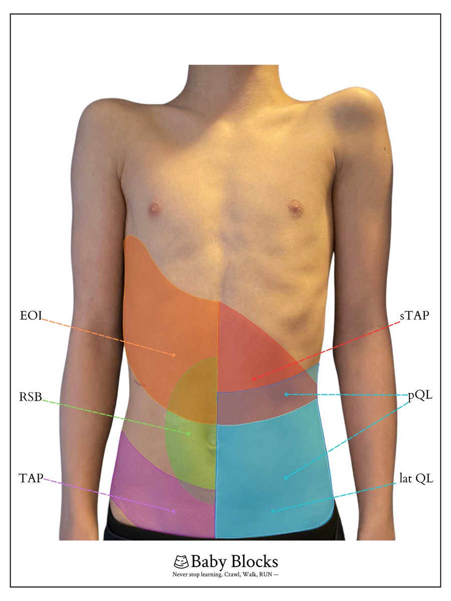 baby-blocks (@baby_blocks) on Twitter photo Abdominal truncal blocks have transformed pediatric regional anesthesia—but remember, one size doesn’t fit all! Sometimes, a mix-and-match approach is just what’s needed.
#babyblocks <a href="/PedsPainMed/">Society for Pediatric Pain Medicine</a> <a href="/ASRA_Society/">ASRA Pain Medicine</a> <a href="/PediAnesthesia/">SPA</a> <a href="/ESRA_Society/">ESRA | European Society of Regional Anaesthesia</a>
baby-blocks.com/abdomen Abdominal truncal blocks have transformed pediatric regional anesthesia—but remember, one size doesn’t fit all! Sometimes, a mix-and-match approach is just what’s needed.
#babyblocks <a href="/PedsPainMed/">Society for Pediatric Pain Medicine</a> <a href="/ASRA_Society/">ASRA Pain Medicine</a> <a href="/PediAnesthesia/">SPA</a> <a href="/ESRA_Society/">ESRA | European Society of Regional Anaesthesia</a>
baby-blocks.com/abdomen