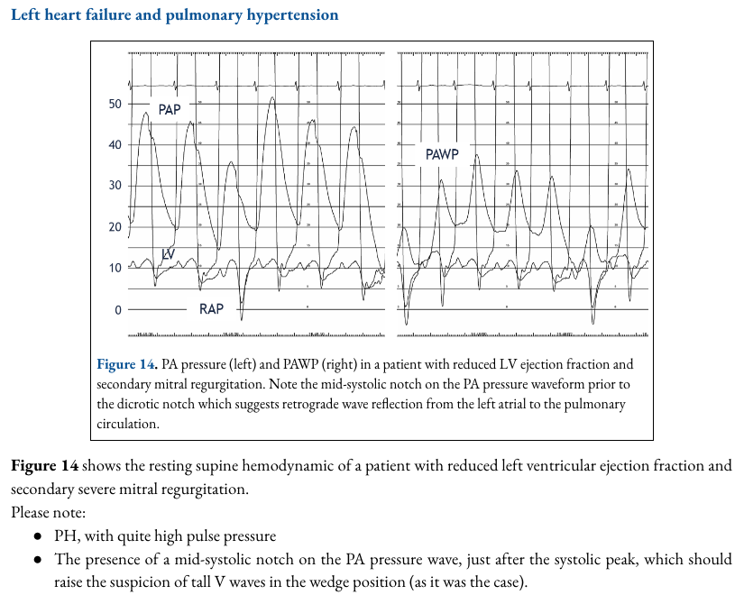Matt Siuba (@msiuba) on Twitter photo We present another publication-quality chapter from ShockWaves, the 1st chapter in the RHC section.
<a href="/CaravitaSergio/">Sergio Caravita</a> presents a masterclass on the invasive PA waveform.
Section editors: <a href="/SophiaAirhartMD/">Sophia Airhart MD</a> & <a href="/zilgiovineMD/">Zachary Il'Giovine</a>
Look out next week for the non-invasive correlates 👀 We present another publication-quality chapter from ShockWaves, the 1st chapter in the RHC section.
<a href="/CaravitaSergio/">Sergio Caravita</a> presents a masterclass on the invasive PA waveform.
Section editors: <a href="/SophiaAirhartMD/">Sophia Airhart MD</a> & <a href="/zilgiovineMD/">Zachary Il'Giovine</a>
Look out next week for the non-invasive correlates 👀