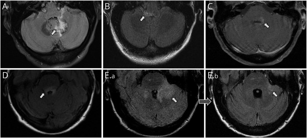Delighted to share <a href="/dinoto_ale/">AleDinoto</a> et al study on the rare cerebellar attacks in #NMOSD attacks: ➡️ Often coexist with brainstem attacks ➡️ MRIs with peduncle or dentate nucleus lesions ➡️ Should be incorporated in upcoming 2025 #NMOSD diagnostic criteria 👇 neurology.org/doi/10.1212/NX…