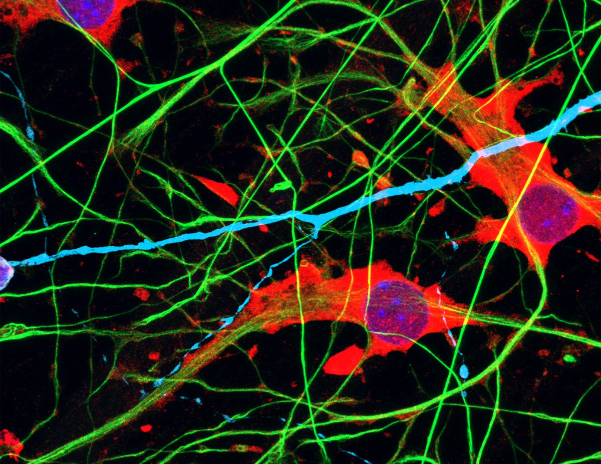 SfNJournals's tweet photo. #SnapshotsinNeuroscience | Featured on the #eNeuro blog, human induced pluripotent stem cell-derived astrocytes and neurons grown in vitro as a coculture from Lendemeijer et al.
Image credit: Bas Lendemeijer
https://t.co/vFIAZhgeAQ https://t.co/TbOoKGd6ys