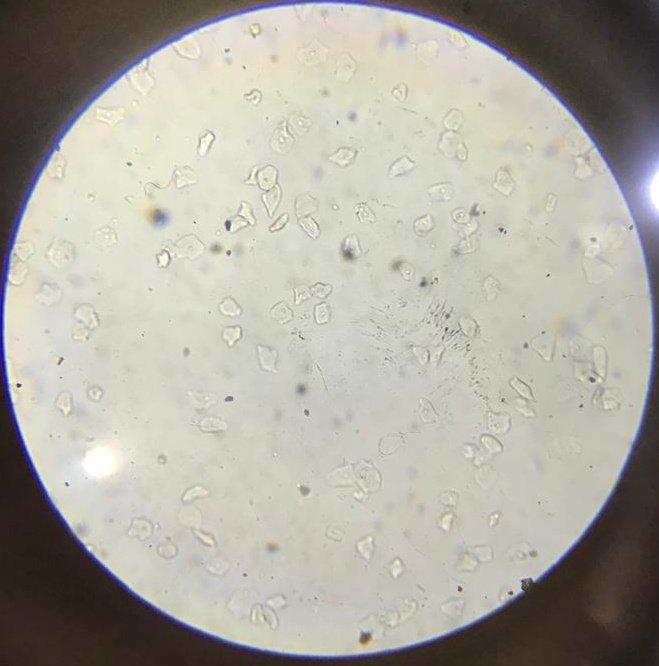 ShololaDamilol2's tweet image. Patient presented with mild free fluid in the pouch of Douglas following an induced abortion. Microbiological analysis revealed the isolation of E. coli from the vaginal fluid.

👉My objective remains to employ a multidisciplinary approach to enhance #reproductive health.