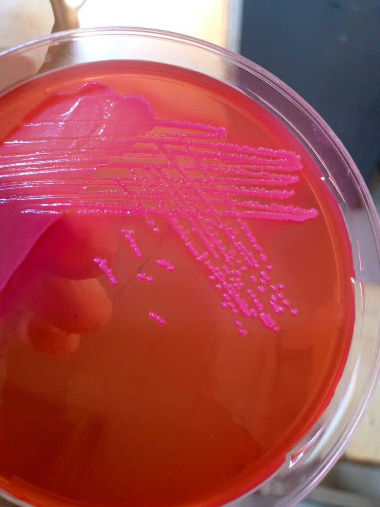 ShololaDamilol2's tweet image. Patient presented with mild free fluid in the pouch of Douglas following an induced abortion. Microbiological analysis revealed the isolation of E. coli from the vaginal fluid.

👉My objective remains to employ a multidisciplinary approach to enhance #reproductive health.