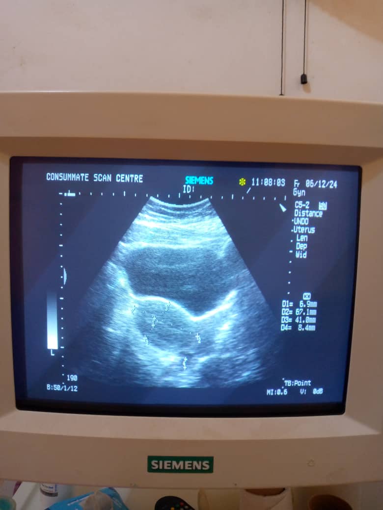 ShololaDamilol2's tweet image. Patient presented with mild free fluid in the pouch of Douglas following an induced abortion. Microbiological analysis revealed the isolation of E. coli from the vaginal fluid.

👉My objective remains to employ a multidisciplinary approach to enhance #reproductive health.