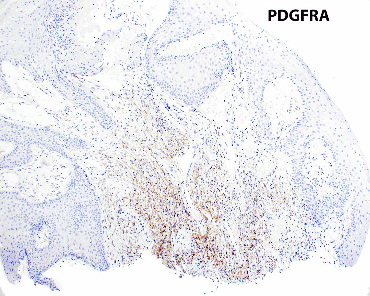 Esophageal inflammatory fibroid polyps are rare and benign. They are generally submucosal-based but this one extended into the lamina propria. PMID: 39259144