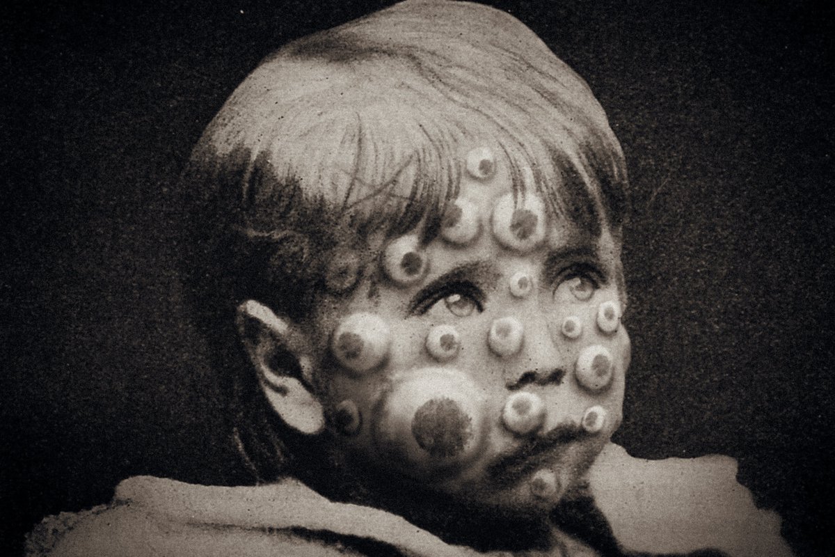 Another blind child has been blessed by Seraph Pox!
Oh, watchful angel. Grant him sight! Through boils and blisters are new eyes born, retinas that see beyond our fragile world. Praise be to you, many-eyed shepherd!