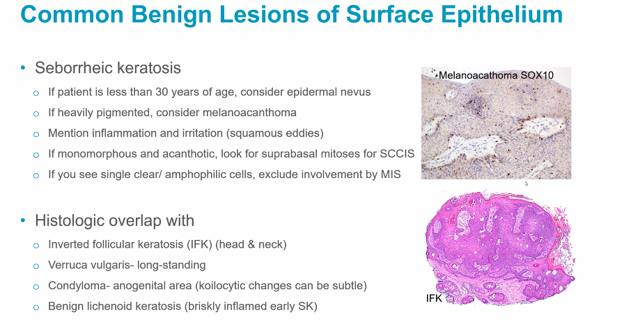 Janiranavarro's tweet photo. #JobPrepBootcamp #DermPath Dr. Nagarajan
Seborrheic Keratosis-Considerations
-If patient is less than 30yo, consider epidermal nevus
-If you see single clear/amphophilic cells, exclude involvement MIS
#CAP #pathology #pathologists #pathresidents #pathfellows #PathTwitter #PathX https://t.co/j5JUoSAtYk