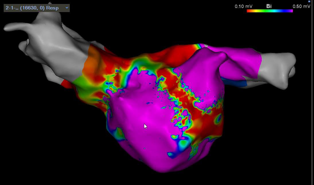 Hakeem Ayinde (@naijaqrs) on Twitter photo 60 M NICM EF 20% with persistent flutter. PVI, PWI done earlier.
Now this mitral flutter. <a href="/AZ_EP_DOC/">AFPanico</a> <a href="/aalahmadmd/">Amin Al-Ahmad, MD</a> <a href="/DrRoderickTung/">Roderick Tung</a> <a href="/AlexTurinMD/">Alex Turin</a> <a href="/AnandShah_MD/">Anand</a> <a href="/rainylakedana/">Dana Johnson MD MPH</a> #EPeeps
Anterior line did not terminate it. Sooo… 60 M NICM EF 20% with persistent flutter. PVI, PWI done earlier.
Now this mitral flutter. <a href="/AZ_EP_DOC/">AFPanico</a> <a href="/aalahmadmd/">Amin Al-Ahmad, MD</a> <a href="/DrRoderickTung/">Roderick Tung</a> <a href="/AlexTurinMD/">Alex Turin</a> <a href="/AnandShah_MD/">Anand</a> <a href="/rainylakedana/">Dana Johnson MD MPH</a> #EPeeps
Anterior line did not terminate it. Sooo…