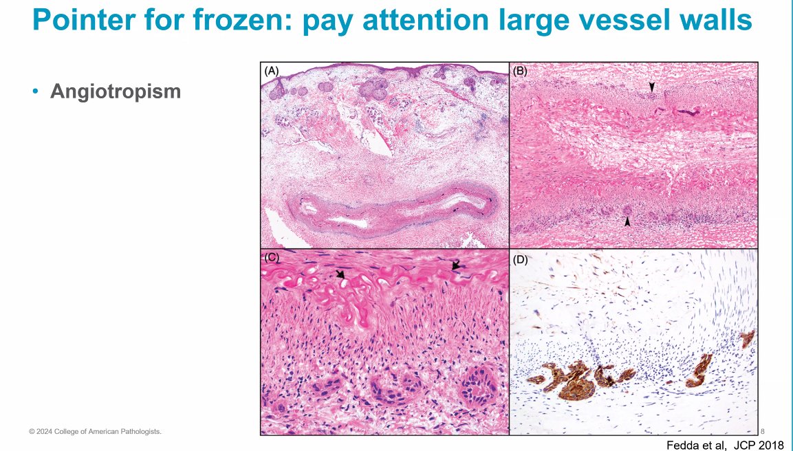 Janiranavarro's tweet photo. #JobPrepBootcamp #DermPath Dr. Nagarajan
SCC in frozen sections: Pay attention to large vessels; the tumor may only be present there (angiotropism)
#CAP #pathology #pathologists #pathresidents #pathfellows #PathTwitter #PathX https://t.co/WpL2UyDN79