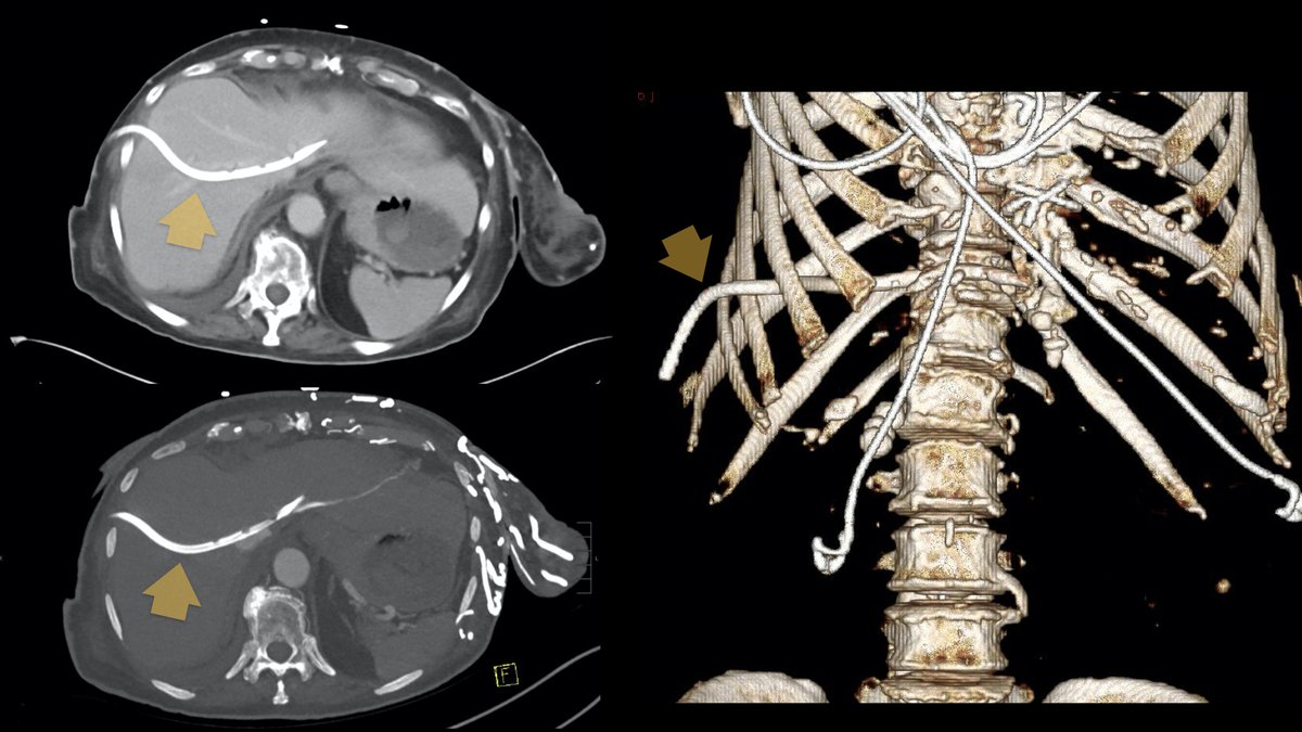[3/3] Bloody output... Unfortunately this chest tube will need to be repositioned. Preferably under imaging guidance this time around! 😉 <a href="/BrighamRad/">Brigham and Women's Radiology</a> <a href="/CsirEtc/">CSIR_ETC_SAR</a> <a href="/CAIRweb/">Canadian Association for Interventional Radiology</a> <a href="/JVIRmedia/">JVIR</a> <a href="/SIRspecialists/">Society of Interventional Radiology</a> <a href="/ATCS_journal/">Annals of Thoracic and Cardiovascular Surgery</a> <a href="/SAR_RFS/">SAR Resident and Fellow Section</a> @sar