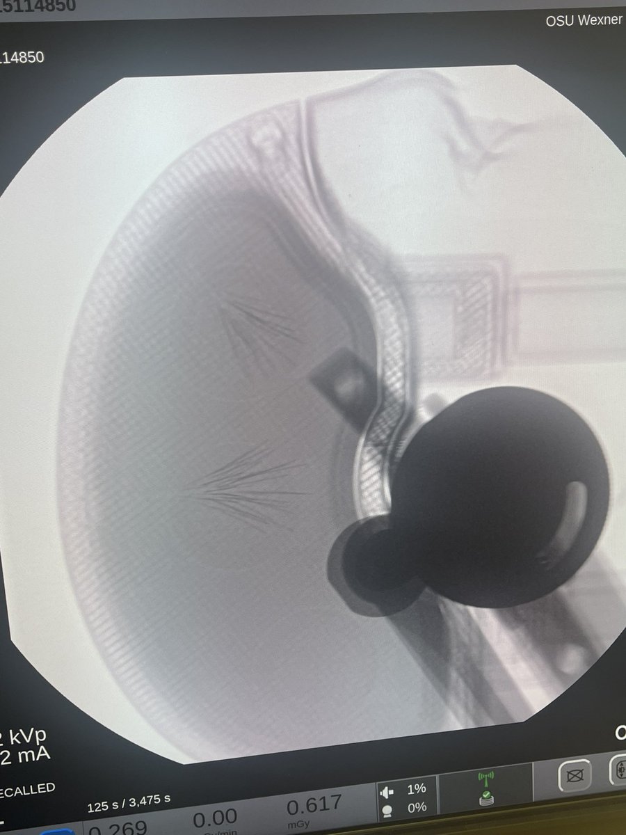 Joshua D. Palmer, MD (@joshuapalmermd) on Twitter photo Making some amazing progress towards being the first ever trial to place alpha particles in the brain for GBM. So excited for our patients and thankful to our huge team and Alpha Tau Medical. <a href="/OhioStateRadOnc/">OhioStateRadOnc</a> <a href="/ASTRO_org/">ASTRO</a> <a href="/ESTRO_RT/">ESTRO</a> <a href="/NeuroOnc/">SNO</a> <a href="/EANOassociation/">EANO</a> <a href="/NeurosurgeryOSU/">Ohio State Neurosurgery Residency</a> Making some amazing progress towards being the first ever trial to place alpha particles in the brain for GBM. So excited for our patients and thankful to our huge team and Alpha Tau Medical. <a href="/OhioStateRadOnc/">OhioStateRadOnc</a> <a href="/ASTRO_org/">ASTRO</a> <a href="/ESTRO_RT/">ESTRO</a> <a href="/NeuroOnc/">SNO</a> <a href="/EANOassociation/">EANO</a> <a href="/NeurosurgeryOSU/">Ohio State Neurosurgery Residency</a>