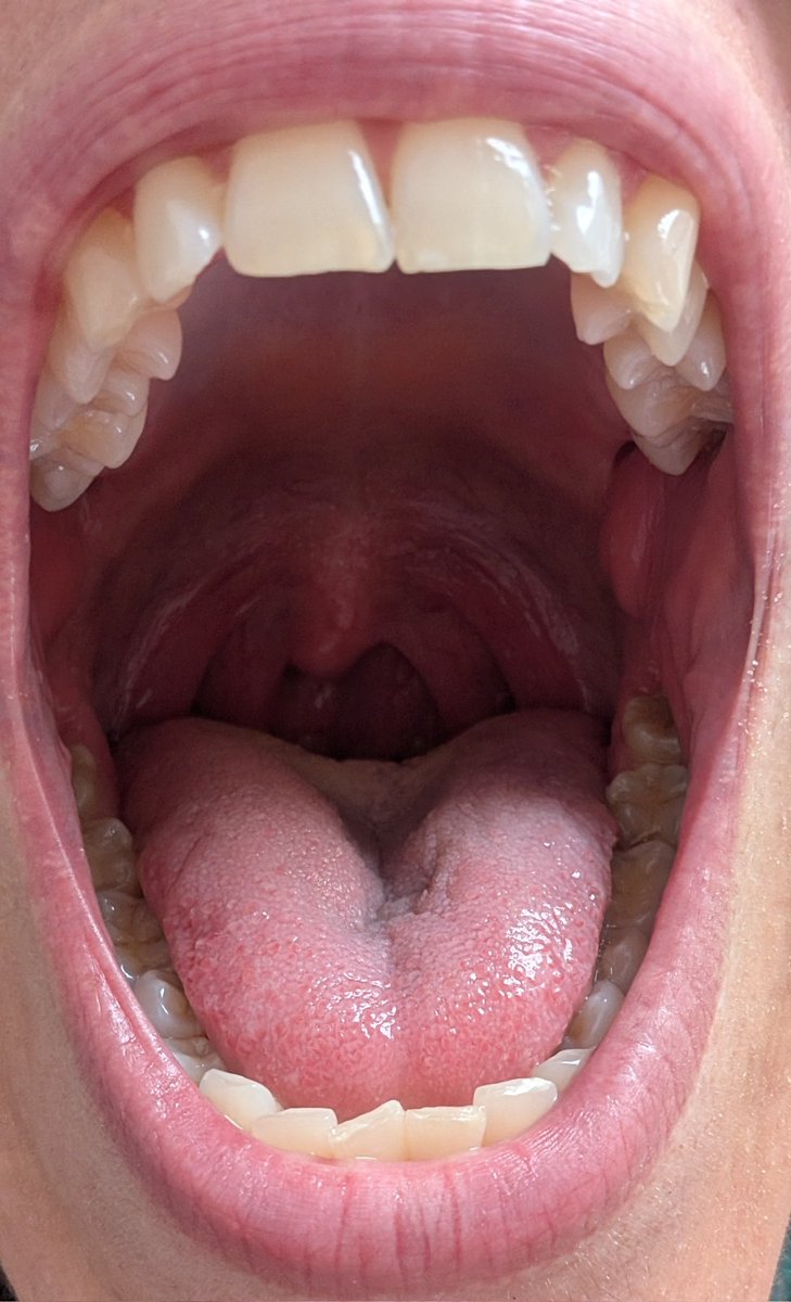 Laying down opening my mouth. Look how my uvula just retracts back. I need a tiny to hold onto it and make sure it's ok. It's a tough job but I am sure you're up to it. One risk. I might swallow.