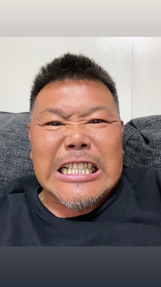 07Chevrolet's tweet photo. 見苦しい写真すんません🙏

#before#after
まだまだ来年も月に1、2回通って歯の治療、掃除やメンテナンスするぜ！
せっかくキレイになったから維持しないとね！
遠いけど頑張って通うよ！
https://t.co/66FNY0w3n8
#斉藤歯���医院
#セラミック 
#おすすめ https://t.co/kMy7veBfFI