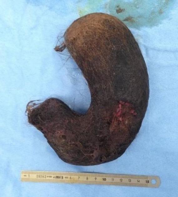 IanDorwardMD's tweet photo. @BowTiedYukon At some point she will likely need that trichobezoar surgically removed from her stomach 
￼
(Source: https://t.co/Zg7GVXrA2k) https://t.co/HhTFWSZDmX