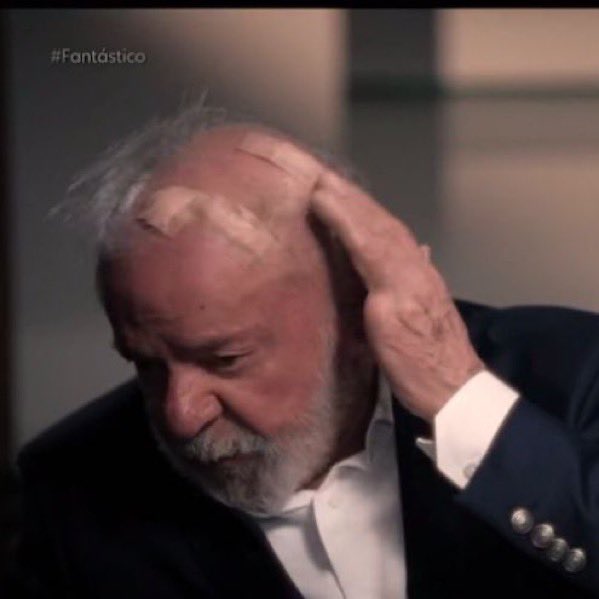 Operou no SUS? Que p@##a é essa que nem a cabeça rasparam. Só os jumentos acreditam nesse teatro de quinta categoria. 🤮