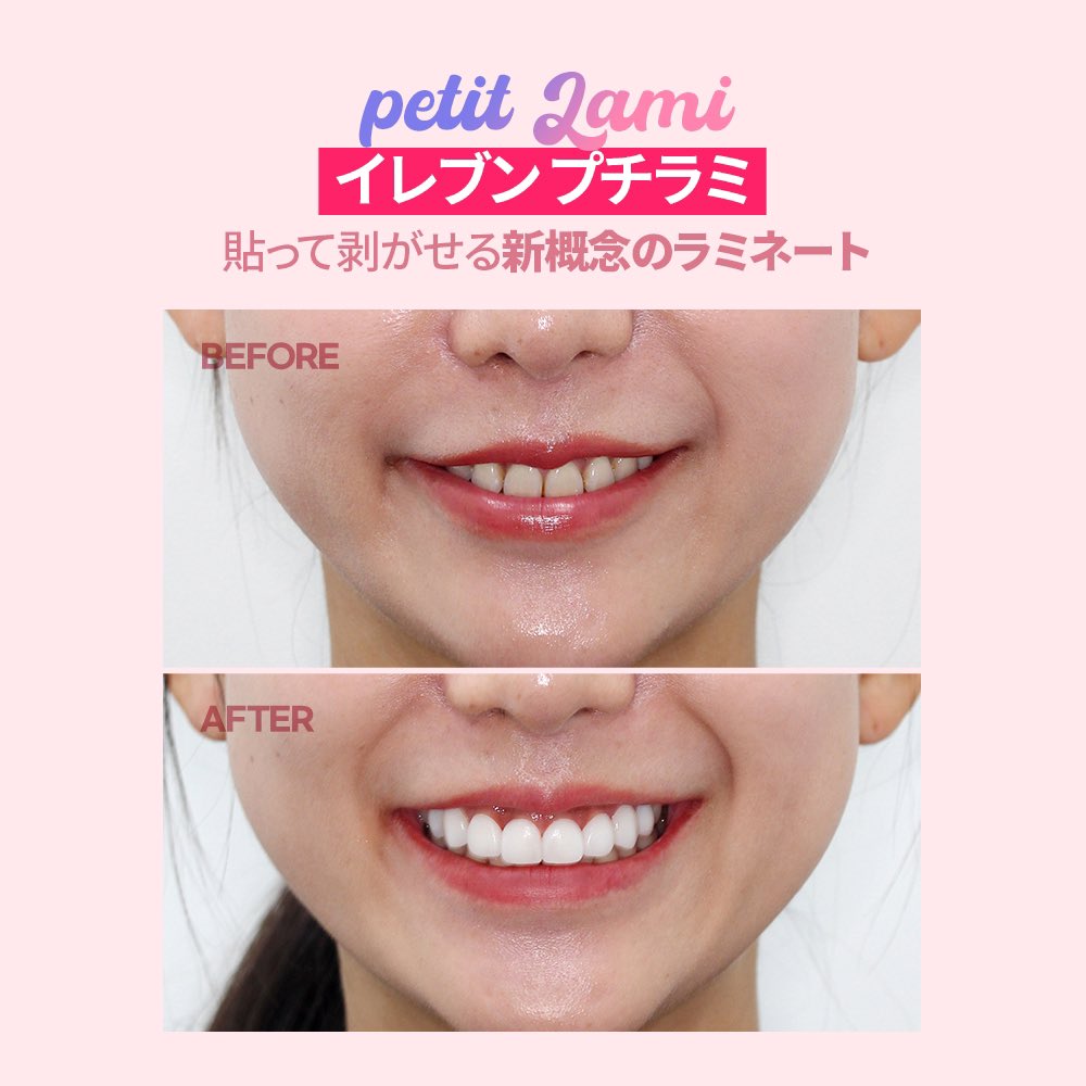 11kyosei_dental's tweet photo. 素早く手軽に綺麗な歯を作ることが出来るプチラミ！
貼って剥がせる新概念のラミネートです♪
面接や写真撮影、結婚式などあなたの大事な瞬間を輝かせます^^
プチラミはご来院頂きデータ作成、数時間後受け取りに来ていただきます。
当日お渡し可能なので韓国旅行に来られる方、ぜひ一度ご体験ください https://t.co/pTWTmwfYT2