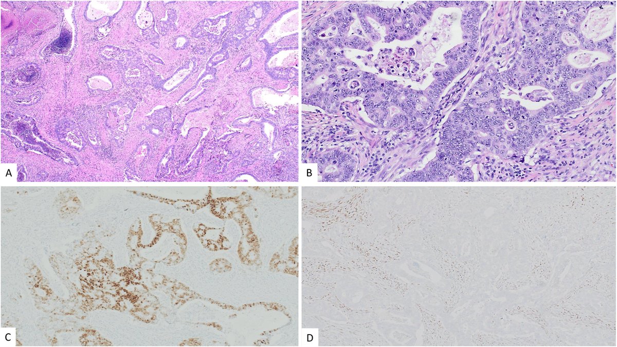 Human_Pathology's tweet photo. New in #HumPathol: Characterization of Gastric/Gastrointestinal-Like Immunophenotypes in Endometrial Endometrioid Adenocarcinomas, Including Endometrioid Adenocarcinomas with Mucinous Differentiation. https://t.co/KBjbzcLOiH #pathology #PathTwitter #PathX #GYNpath https://t.co/B1aioUfSda