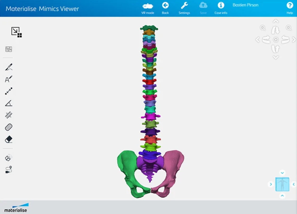 nittinpatil's tweet image. Materialise Launches Integrated Mimics Platform to Accelerate Adoption of Personalized Medical Care

dailycadcam.com/materialise-la… via @dailycadcam

@MaterialiseNV #MaterialiseMimics #PersonalizedHealthcare #Medical3DPrinting #Medical3DPlanning #MedicalDeviceIndustry #CAM