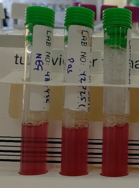 #MorphologyMonday

"Hi," said the person on the phone. "Can you please take a look at the film for this patient urgently. And also do the screening test?"

"Sure thing. Give me 15 mins," I replied.

What do the blood film and the screening result show?

#OnlyCells #RedCells